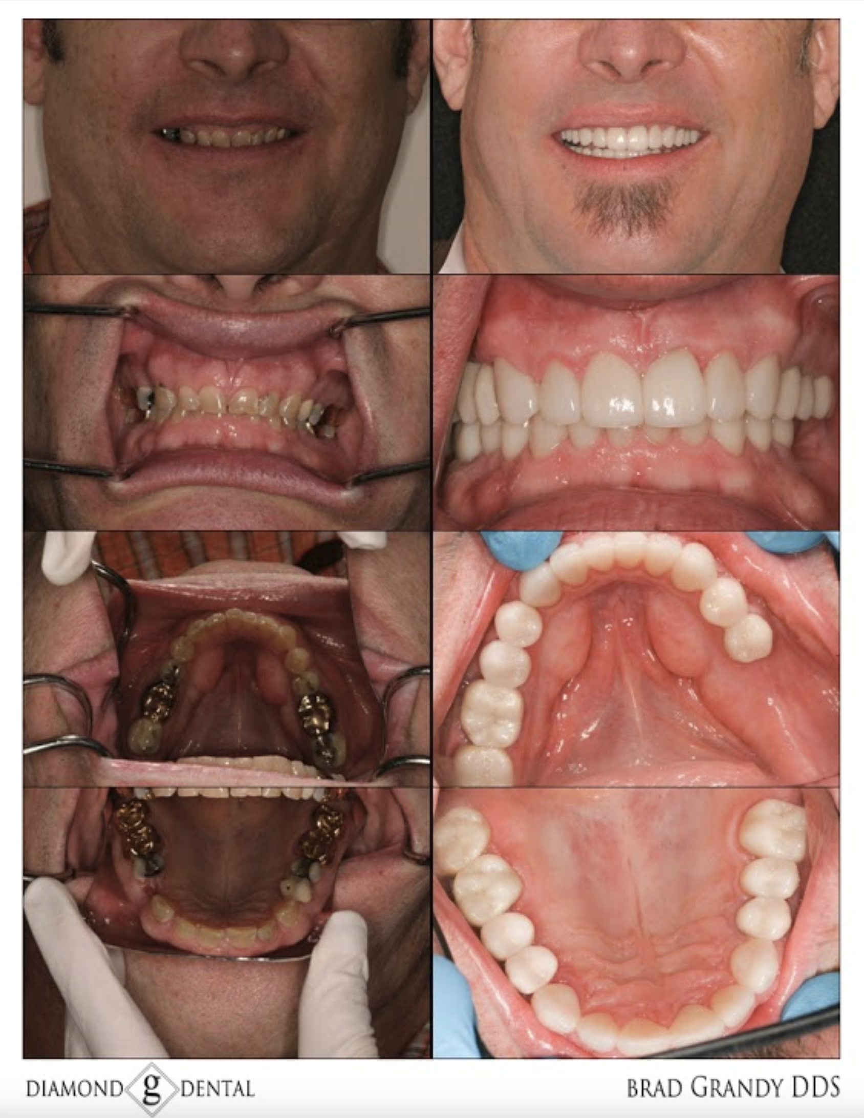 Full Mouth Reconstruction