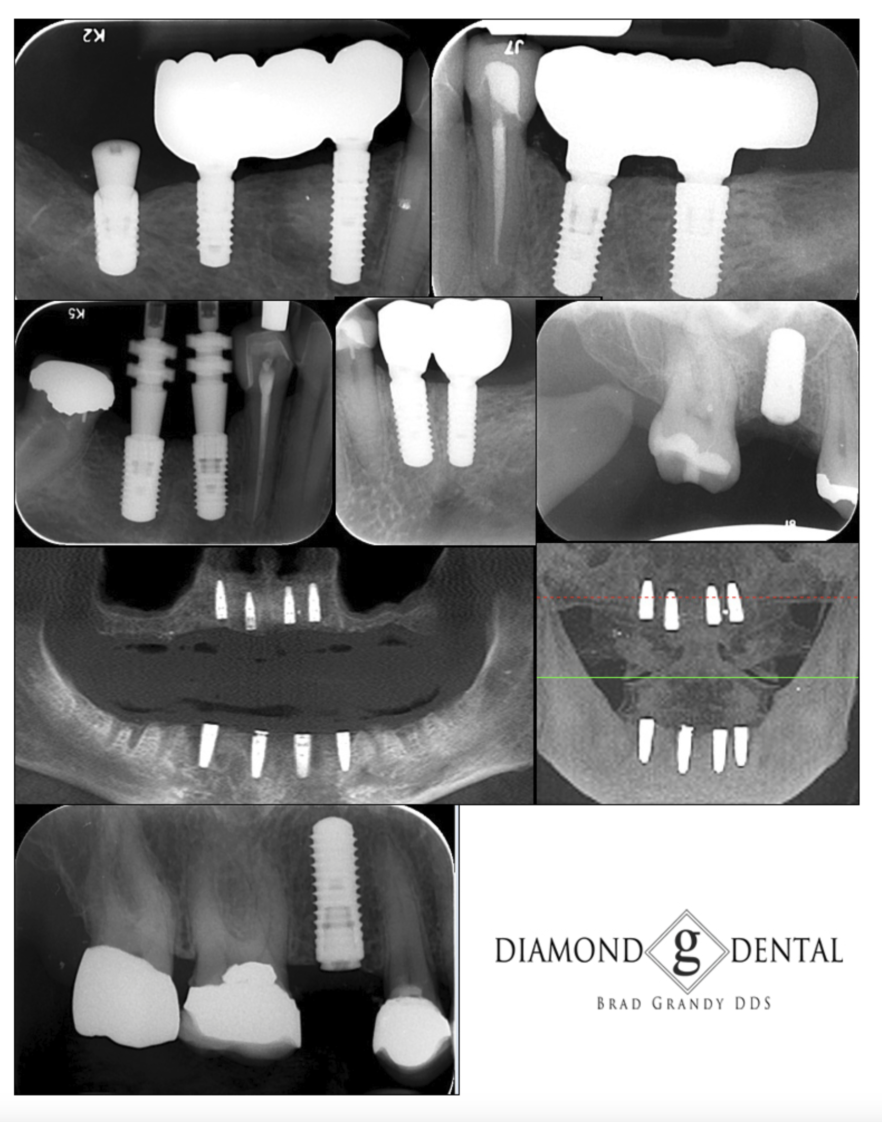 Dental Implants