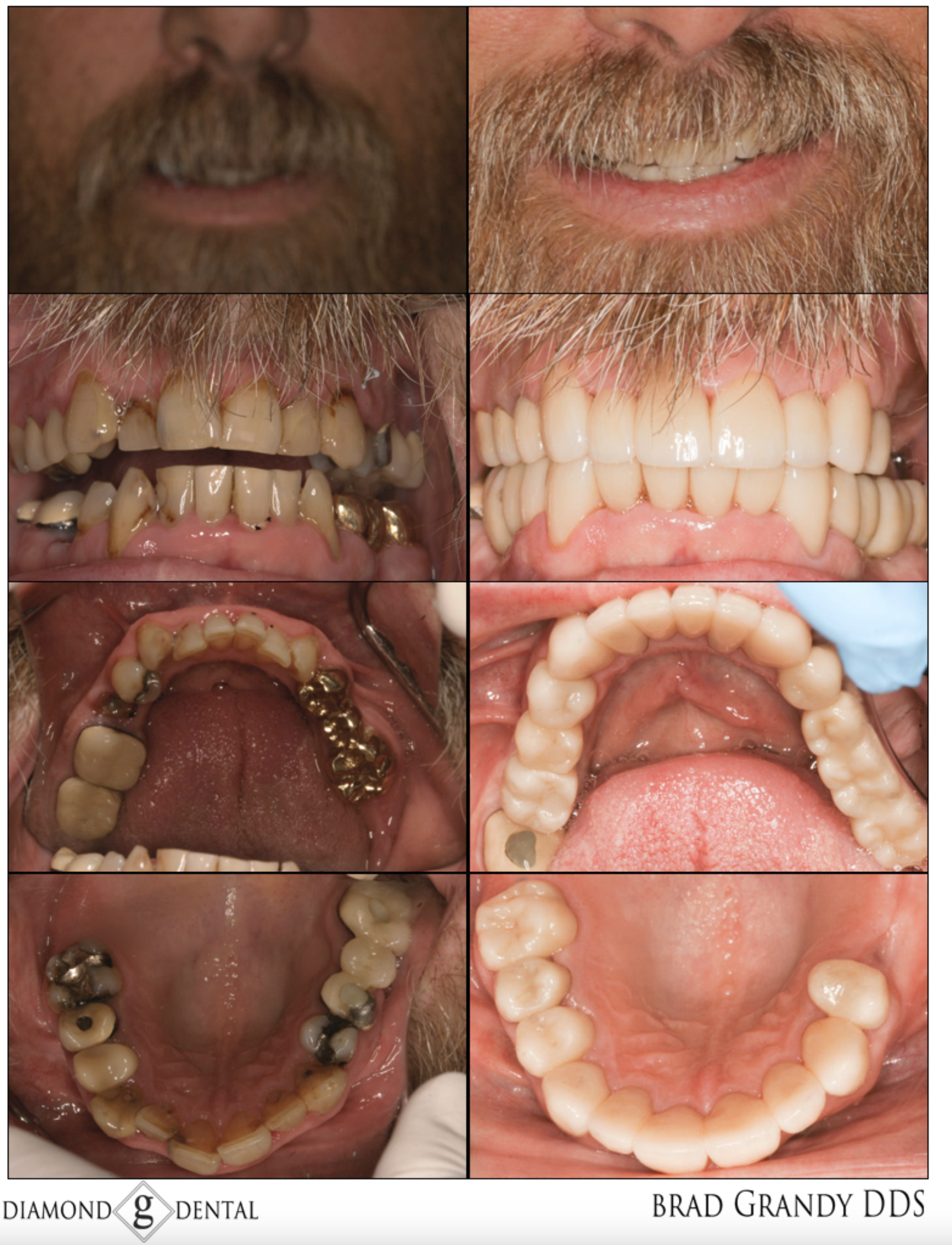 Full Mouth Reconstruction