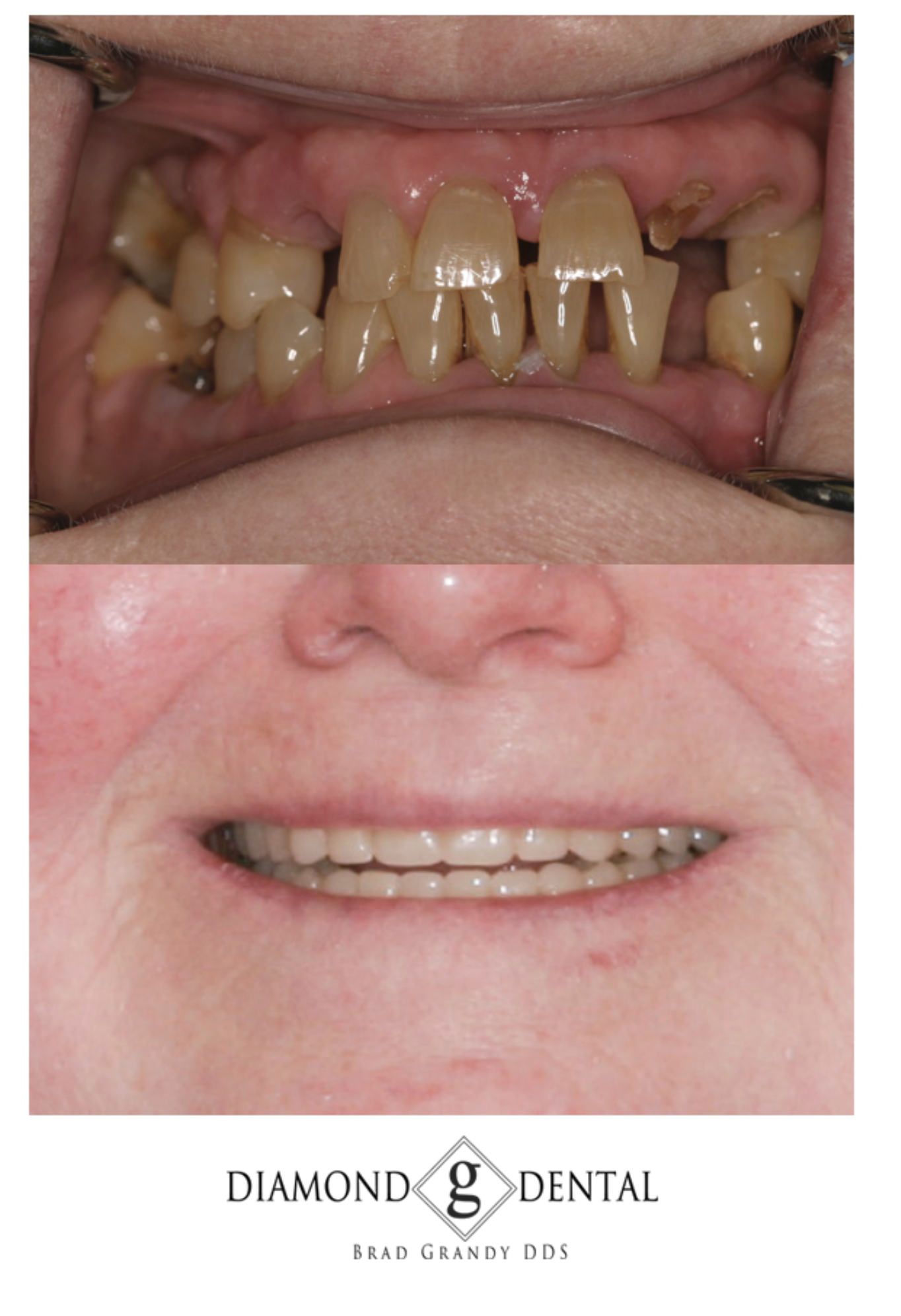 Implant Retained Denture