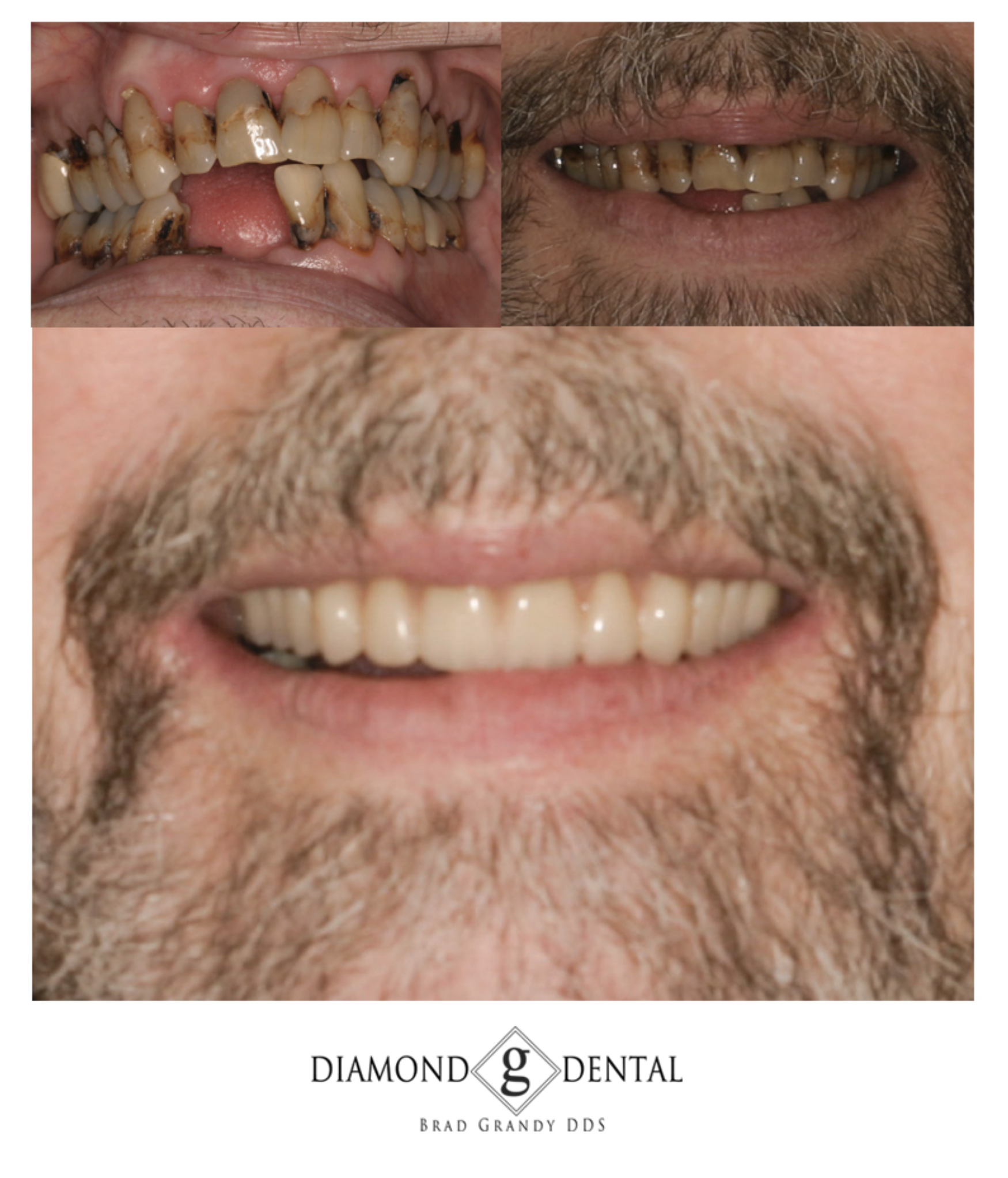 Implant Retained Denture