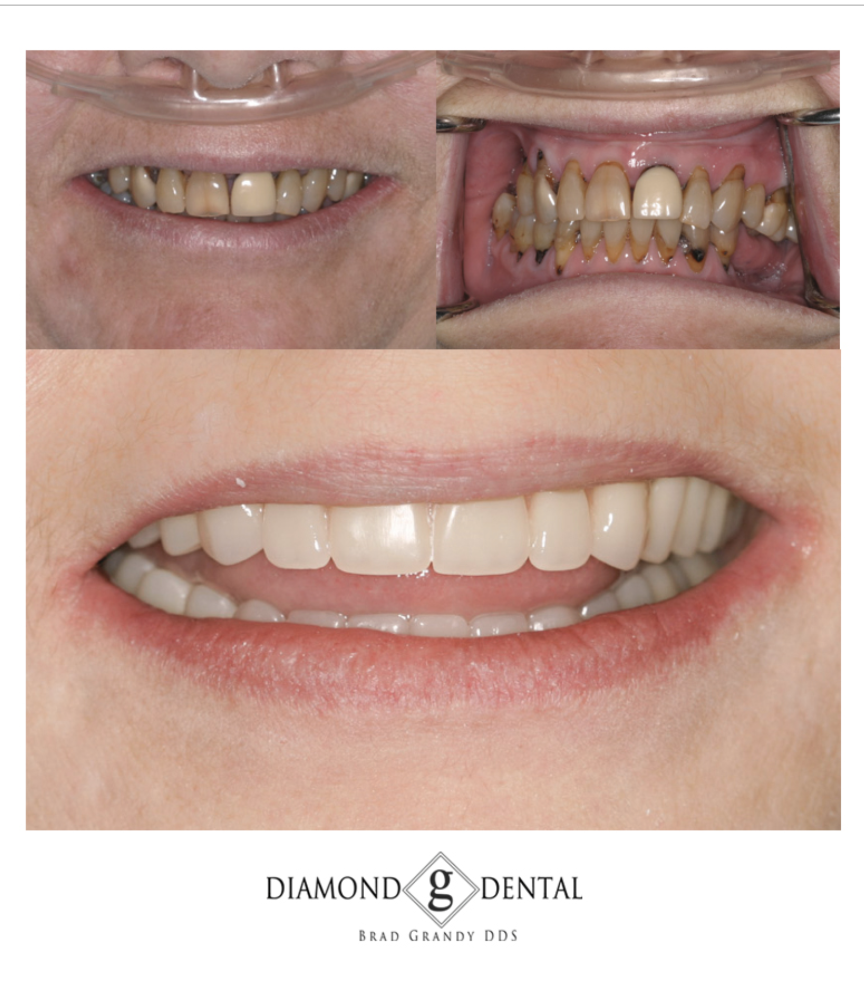 Implant Retained Denture